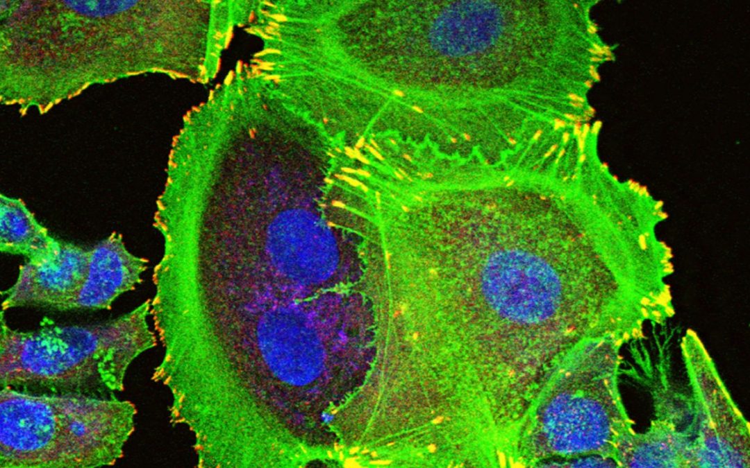 POPs : quels impacts sur le cancer du sein ?