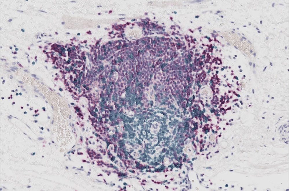 Lymphocytes B : de nouveaux alliés pour le traitement des sarcomes par immunothérapie ?