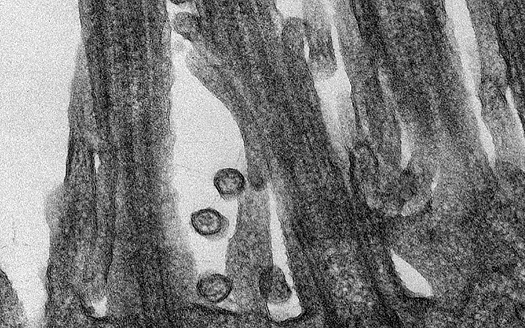 Covid-19 : 15 % des formes graves de la maladie s’expliquent par des anomalies génétiques et immunologiques