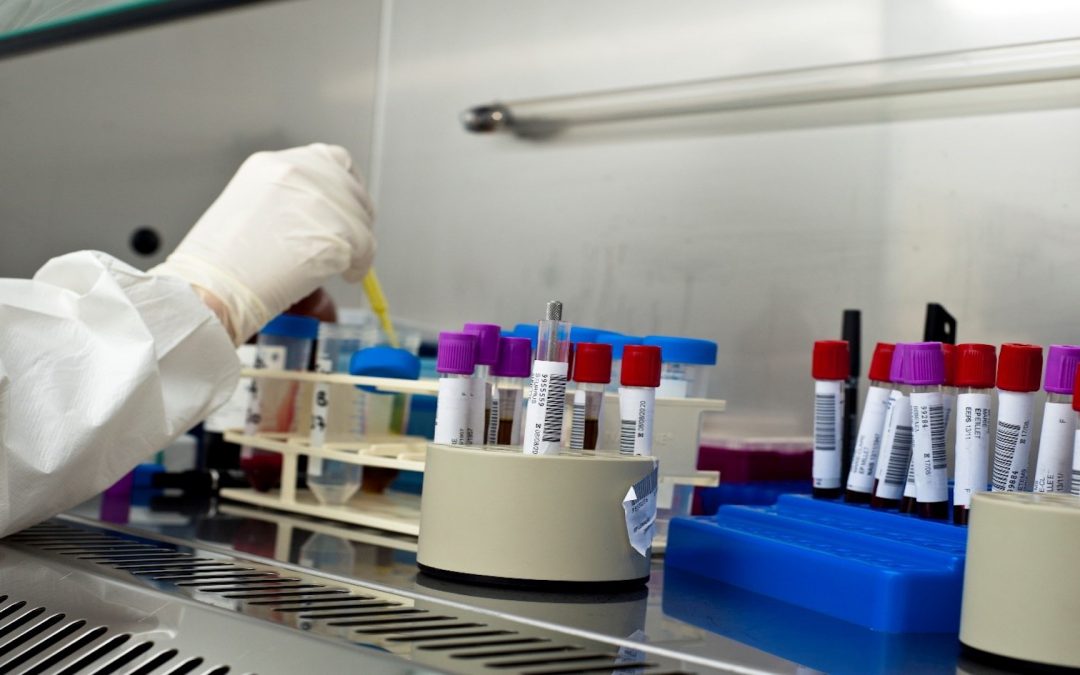 « Signature » immunitaire des patients diabétiques à risque de formes graves de Covid-19