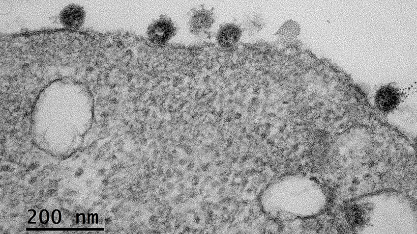 S’intéresser à la charge virale pour comprendre l’évolution vers des formes graves de Covid-19