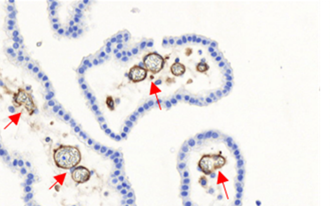 Une avancée majeure dans la compréhension de la prédisposition du nouveau-né aux méningites à streptocoque du groupe B
