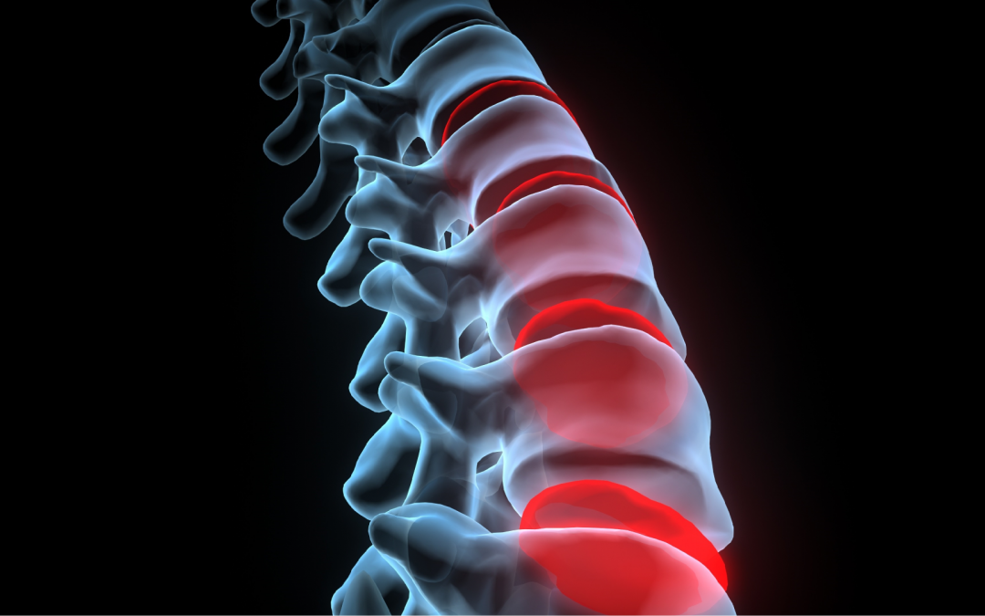 Etude de l’effet des manipulations ostéopathiques chez les patients souffrant de lombalgie