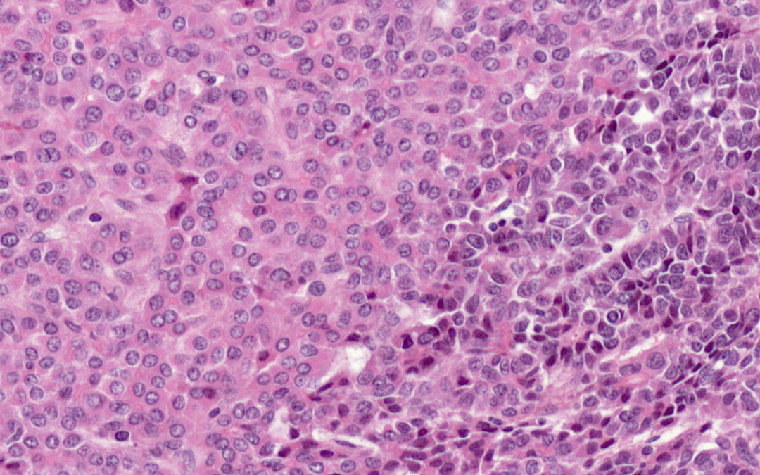 Cancers du foie de l&rsquo;enfant : plasticité tumorale et résistance à la chimiothérapie