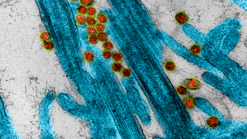 Covid longue : 60 % des patients hospitalisés présentent au moins un symptôme après 6 mois