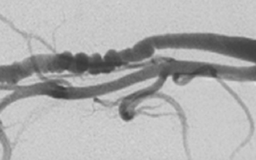 Découverte de nouveaux marqueurs génétiques à l’origine d&rsquo;une maladie des artères presque essentiellement féminine