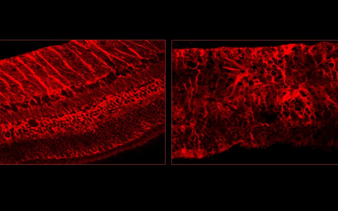 Rétinopathies liées aux diabètes : de nouvelles pistes thérapeutiques très prometteuses