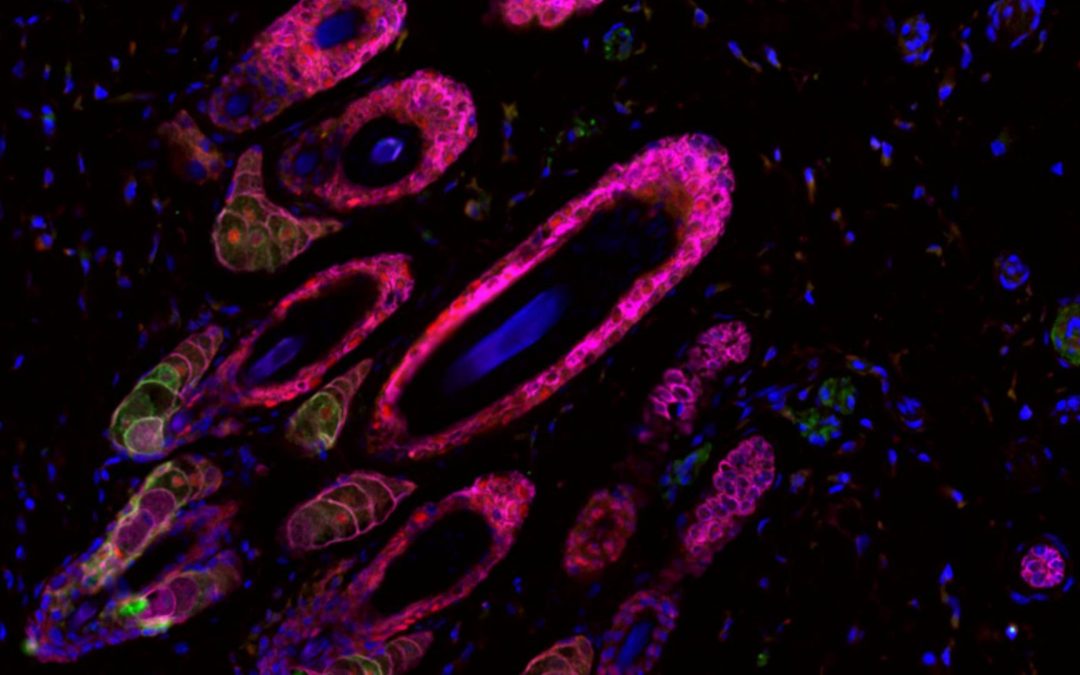 Syndromes d’hypercroissance dysharmonieuse : amélioration de la santé de deux nourrissons atteints de formes sévères