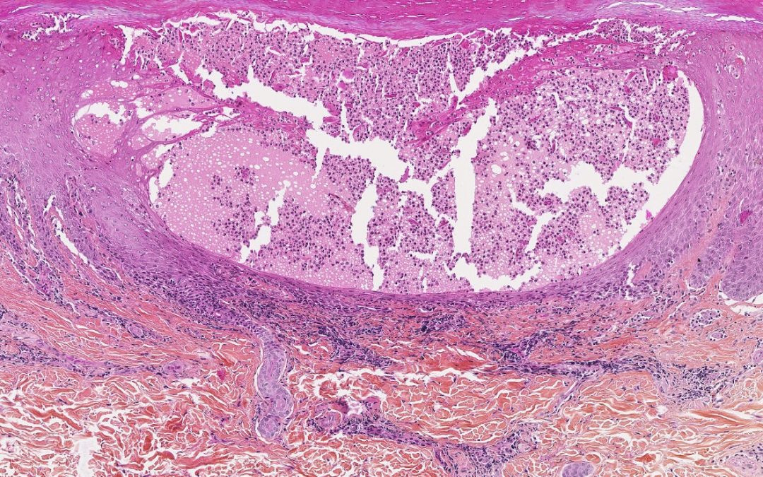 Psoriasis pustuleux généralisé : un anticorps monoclonal humanisé montre son efficacité dans une forme rare et grave de maladie inflammatoire