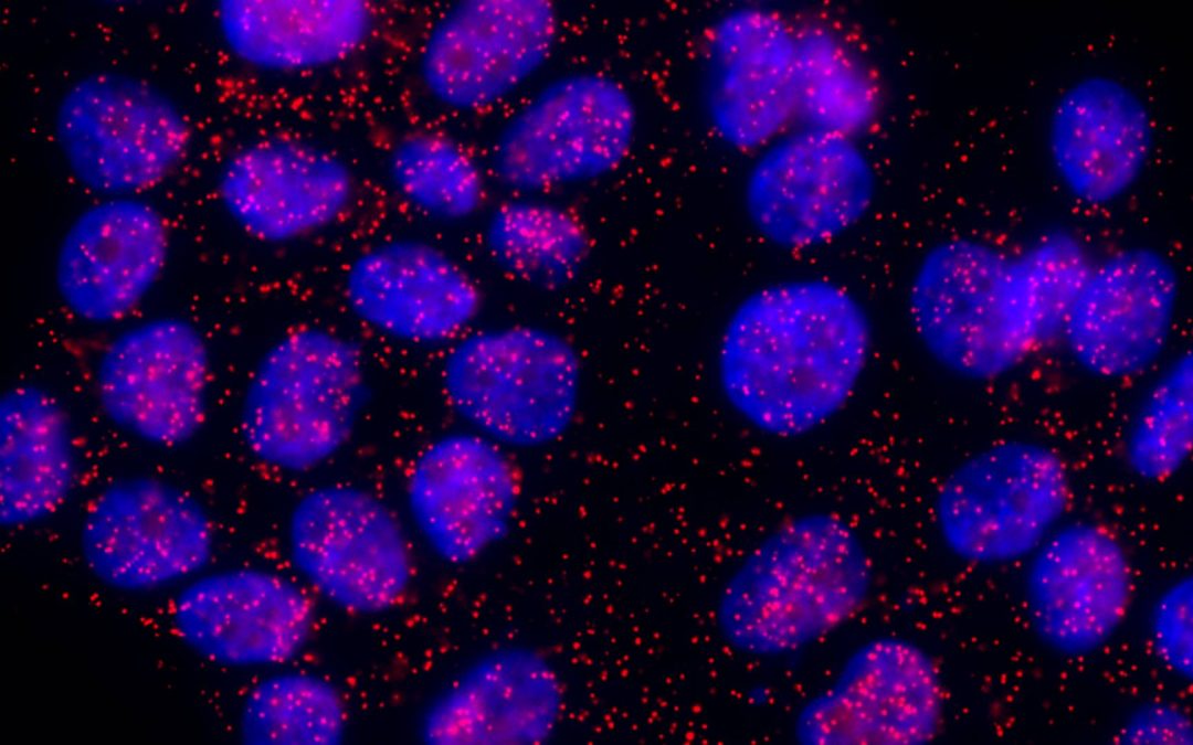 Cancer luminal du sein : une nouvelle association de protéines inhibe l’apparition de métastases