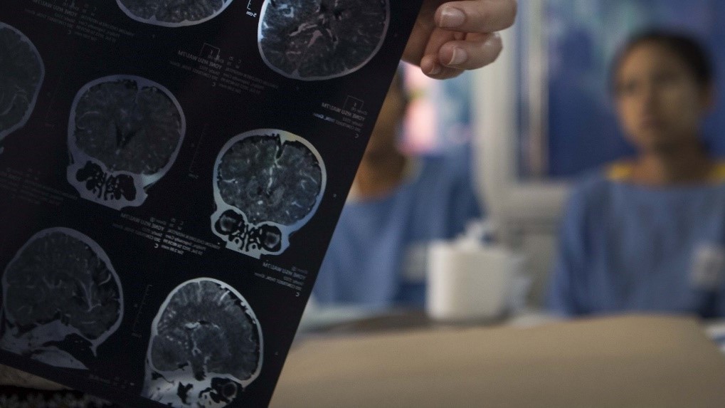 Comment améliorer la prise en charge des encéphalites infantiles en Asie du Sud-Est